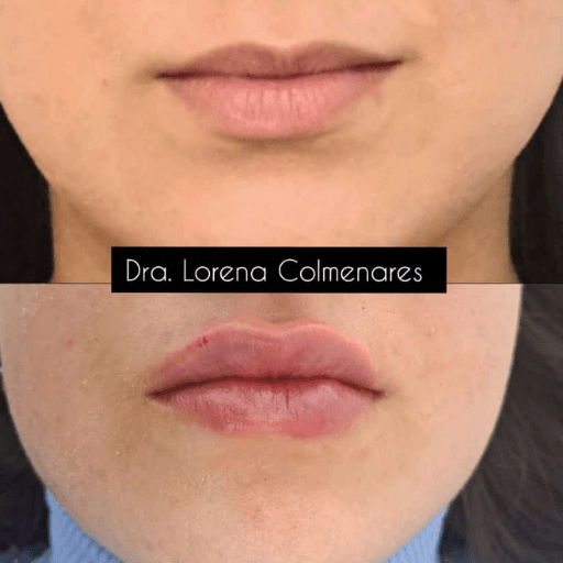 Relleno Labial's image